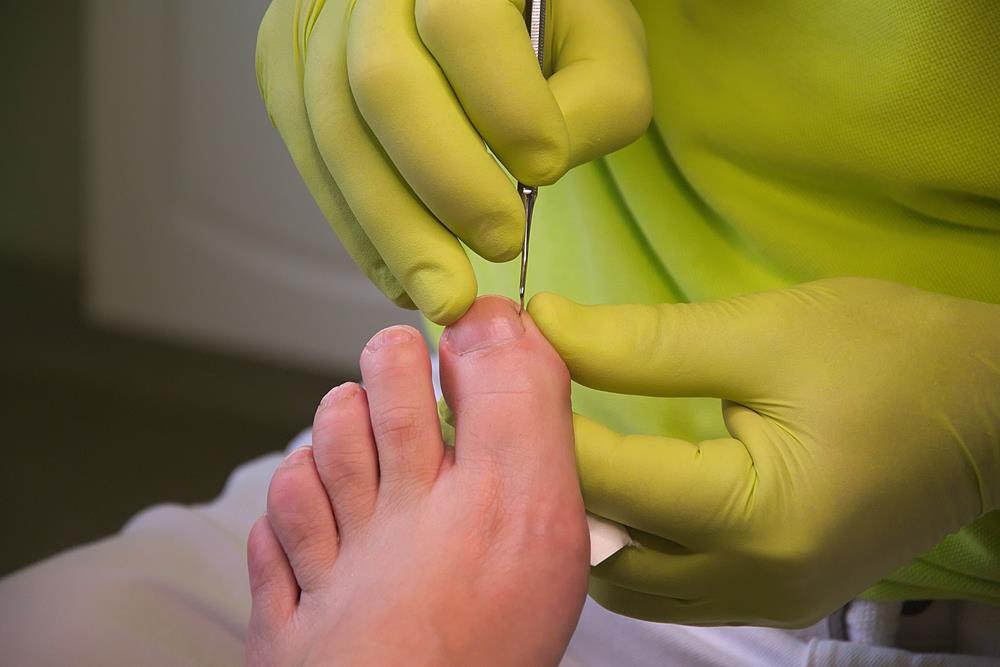 Ingrown Toenails  Bloomingdale, IL 